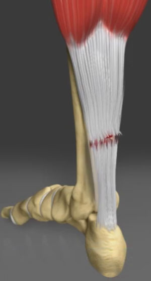 Achilles Tendon Repair