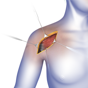 Am I a Candidate for Shoulder Surgery?