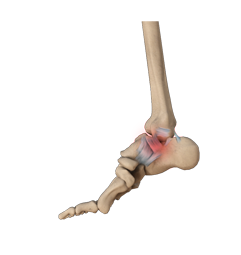 Ankle Sprain