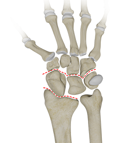 Carpal Instability