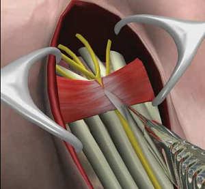 Carpal Tunnel Release