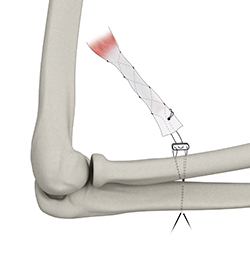 Distal Biceps Avulsion