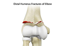 Distal Humerus Fractures