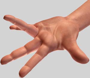 Dupuytrens Contracture