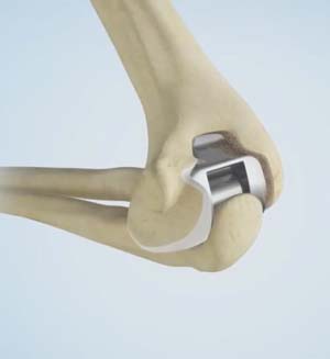 Total Elbow Replacement