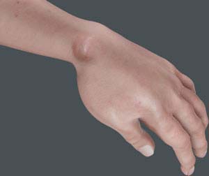 Ganglion Cyst