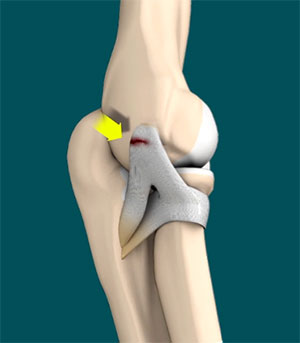 Lateral Ulnar Collateral Ligament