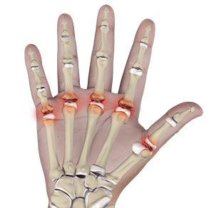 Metacarpophalangeal Joint Arthritis