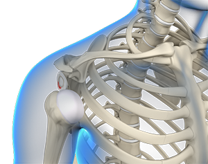 Multidirectional Instability of the Shoulder