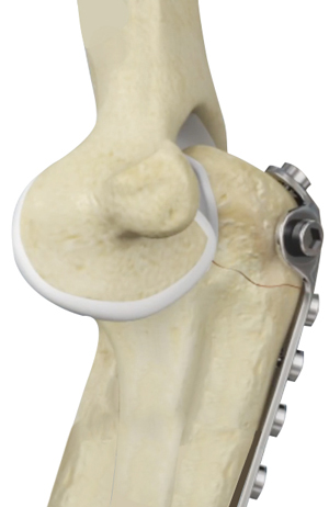 ORIF of the Olecranon Fractures