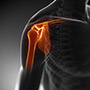 Subacromial Impingement Syndrome