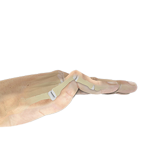 Swan Neck Deformity