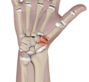 Triscaphoid Joint Arthritis