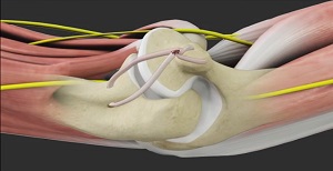 Tommy John Surgery