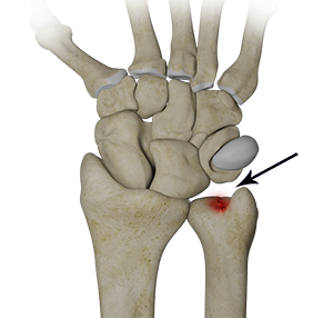 Ulnar Carpal Impaction