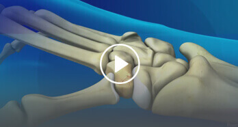 Thumb Arthroplasty